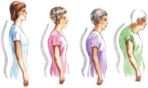 Changes in posture as we age